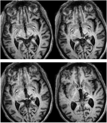 Deafferentation of the Superior Colliculus Abolishes Spatial Summation of Redundant Visual Signals